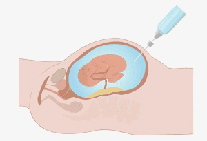 Amniotic Fluid Cytology