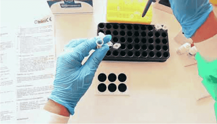 Antistreptolysin O Titer (ASO Test)