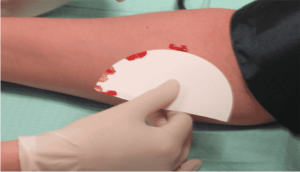 Clotting Time by Lee-White