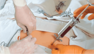 Bone Marrow Examination (Aspirate and Biopsy)