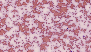 Cold Agglutinin Screen