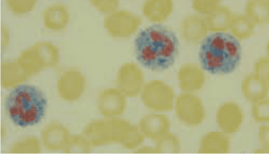 LAP Test (Leukocyte Alkaline Phosphatase)