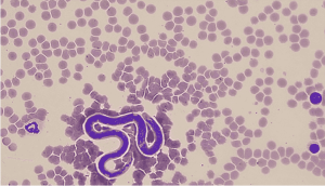 Microfilariae Test: Blood Smear for Filarial and Trypanosomal Parasites