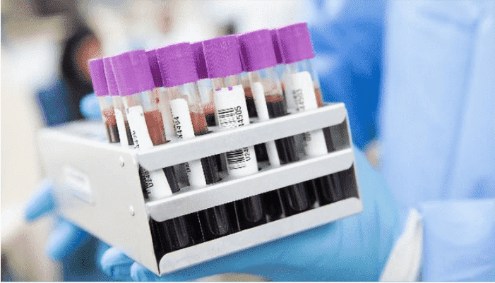 Mumps Serology Test