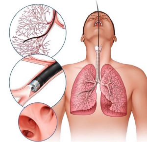 Bronchial Washings Cytology