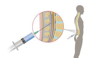 Cerebrospinal Fluid (CSF) Cytology